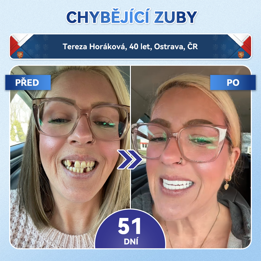 🎊Glimmerly® 🦷Microneedle naplast pro opravu zubi a dasni s Tideglusibem  |Pokročilé zubní pásky s aktivací kmenových buněk (obnovuje sklovinu a dentin • posiluje dásně • odstraňuje plak a zápach • zastavuje citlivost zubů) 3.0