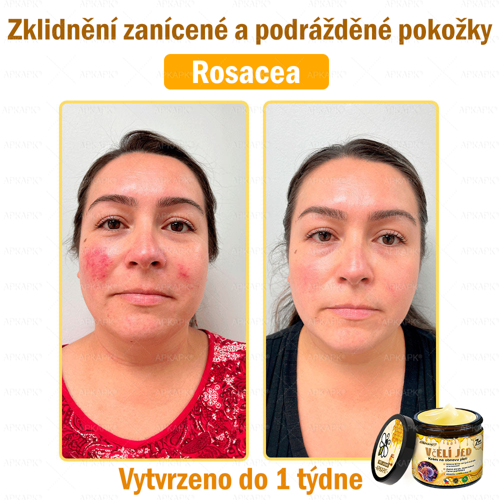 🐝Dermatologicky a klinicky testováno👩‍⚕️APKAPK®Bee Venom Krém na obnovení pleti🐝 pomáhá při léčbě kožních problémů, jako jsou: vrásky, jizvy, pigmentové skvrny, strie, akné, psoriáza, ekzém, kožní změny, podráždění, záněty a další kožní problémy.