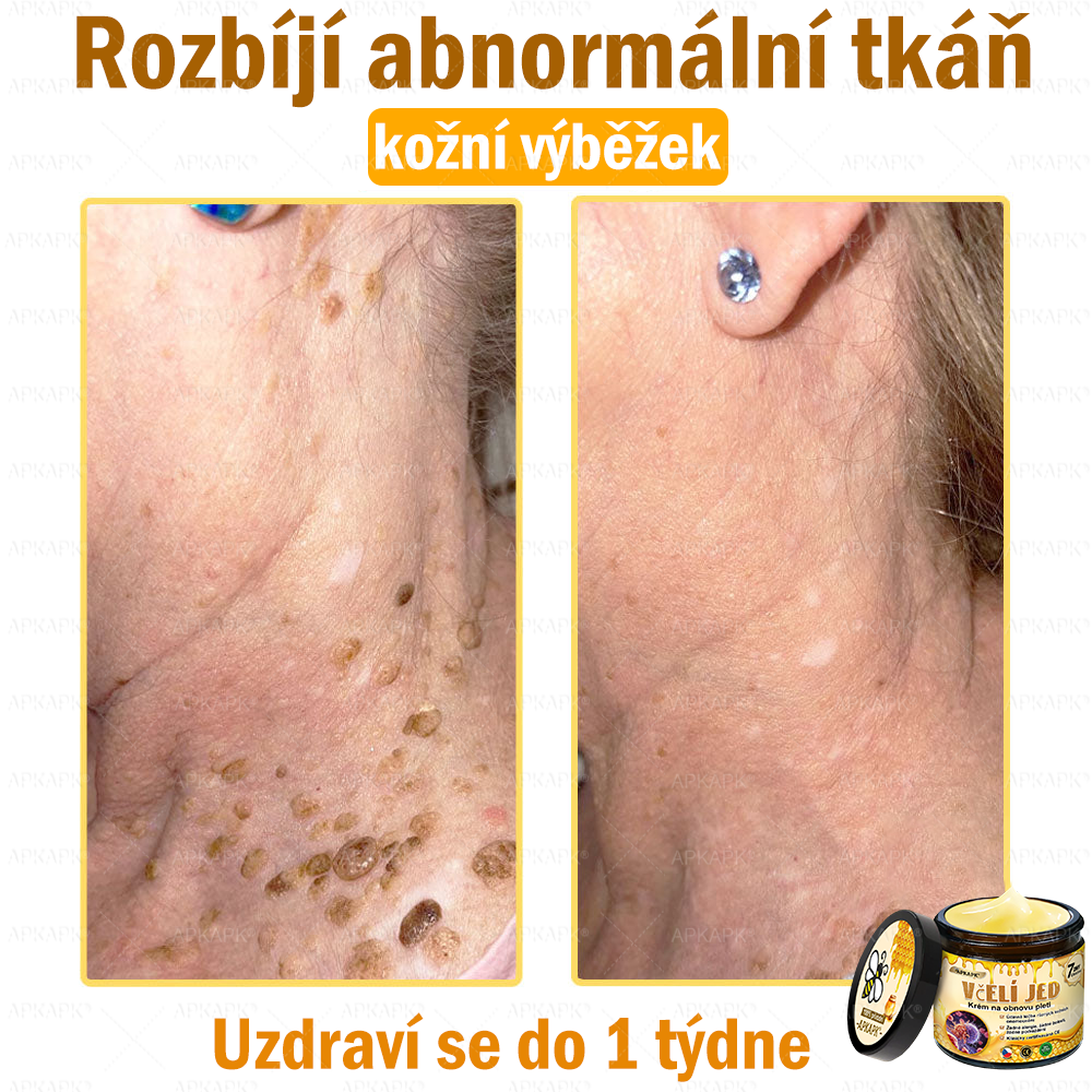 🐝Dermatologicky a klinicky testováno👩‍⚕️APKAPK®Bee Venom Krém na obnovení pleti🐝 pomáhá při léčbě kožních problémů, jako jsou: vrásky, jizvy, pigmentové skvrny, strie, akné, psoriáza, ekzém, kožní změny, podráždění, záněty a další kožní problémy.
