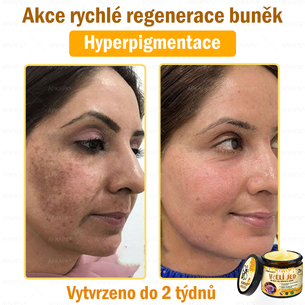 🐝Dermatologicky a klinicky testováno👩‍⚕️APKAPK®Bee Venom Krém na obnovení pleti🐝 pomáhá při léčbě kožních problémů, jako jsou: vrásky, jizvy, pigmentové skvrny, strie, akné, psoriáza, ekzém, kožní změny, podráždění, záněty a další kožní problémy.